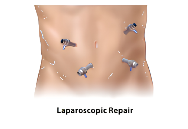 Umbilical hernia repair sequence